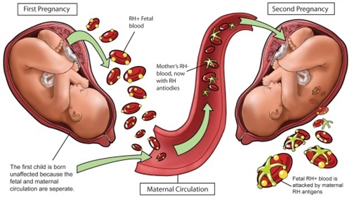 C:\Users\Dr.Ashoush\Desktop\New folder\Erythroblastosis Fetalis.jpg