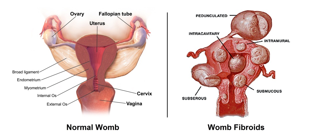 C:\Users\Dr.Ashoush\Desktop\New folder\fibroids.jpg