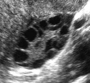 C:\Users\Dr.Ashoush\Downloads\polycystic_ovary[1] (2).jpg