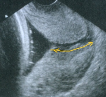 D:\records\my clinics patients data\sherif info sheets\pics for leaflets\cervical length10.jpg