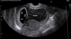 subchorionic hematoma