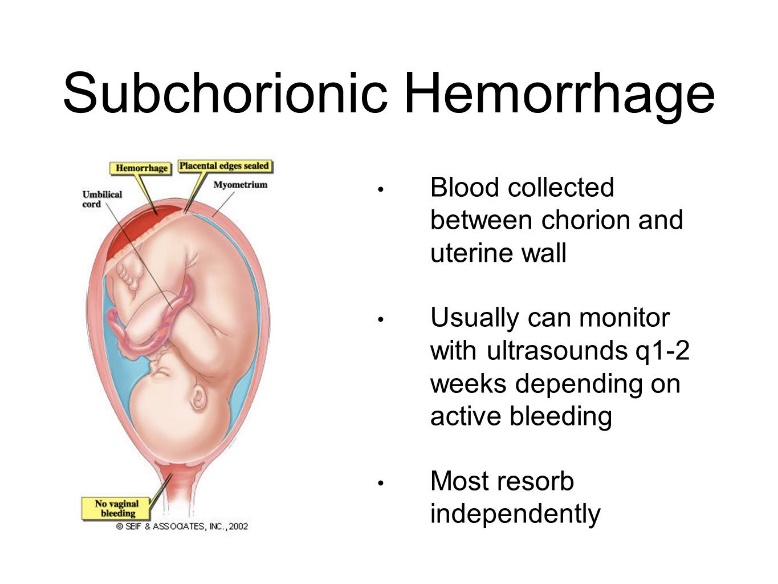 Subchorionic+Hemorrhage