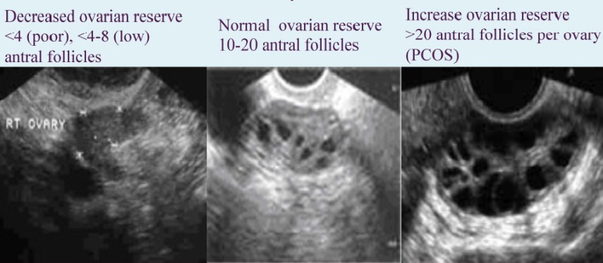 C:\Users\DR. Sherif\Desktop\pictures for website and leaflets\videos\TV shows\إضطراب الدورة الشهرية فى الشباب\سونار عدد البويضات بين الطبيعى وحالات التكيس وحالات نقص المخزون.jpg
