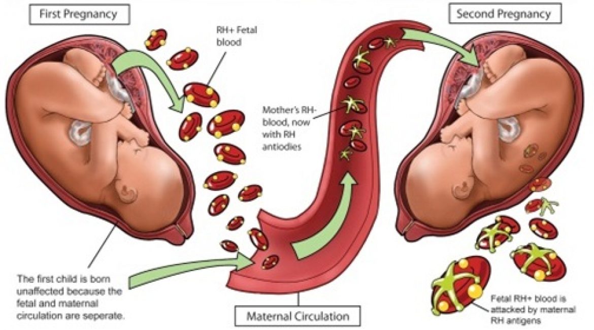 Effect of Maternal Blood Group on the Pregnancy Outcome