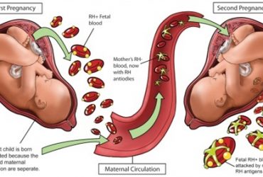 Effect of Maternal Blood Group on the Pregnancy Outcome