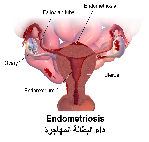 C:\Users\DR. Sherif\Desktop\corrected leaflets\ألام الدورة\ألام الدورة\8 داء البطانة المهاجرة.jpg