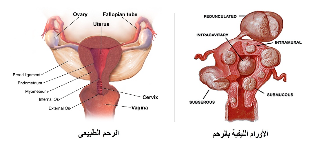 C:\Users\DR. Sherif\Desktop\corrected leaflets\ألام الدورة\ألام الدورة\6 ورم ليفى.jpeg