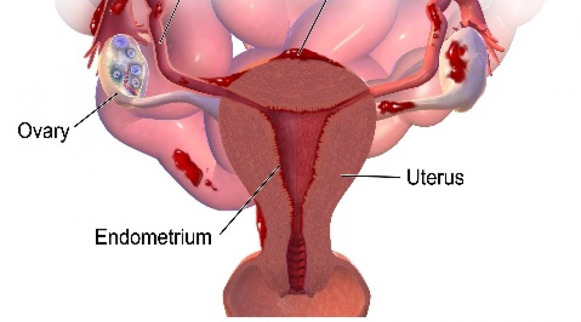 Endometriosis