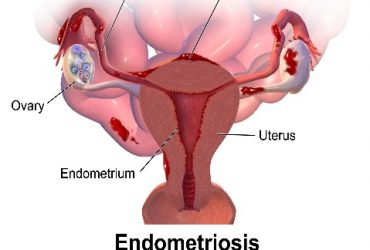 Endometriosis