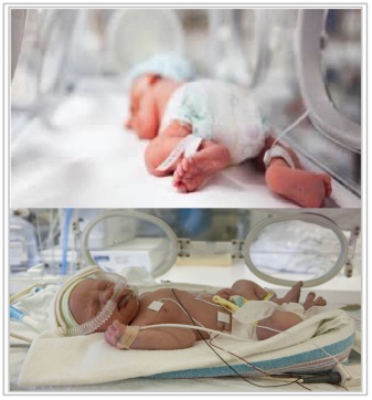 Preterm Delivery: Causes and treatment