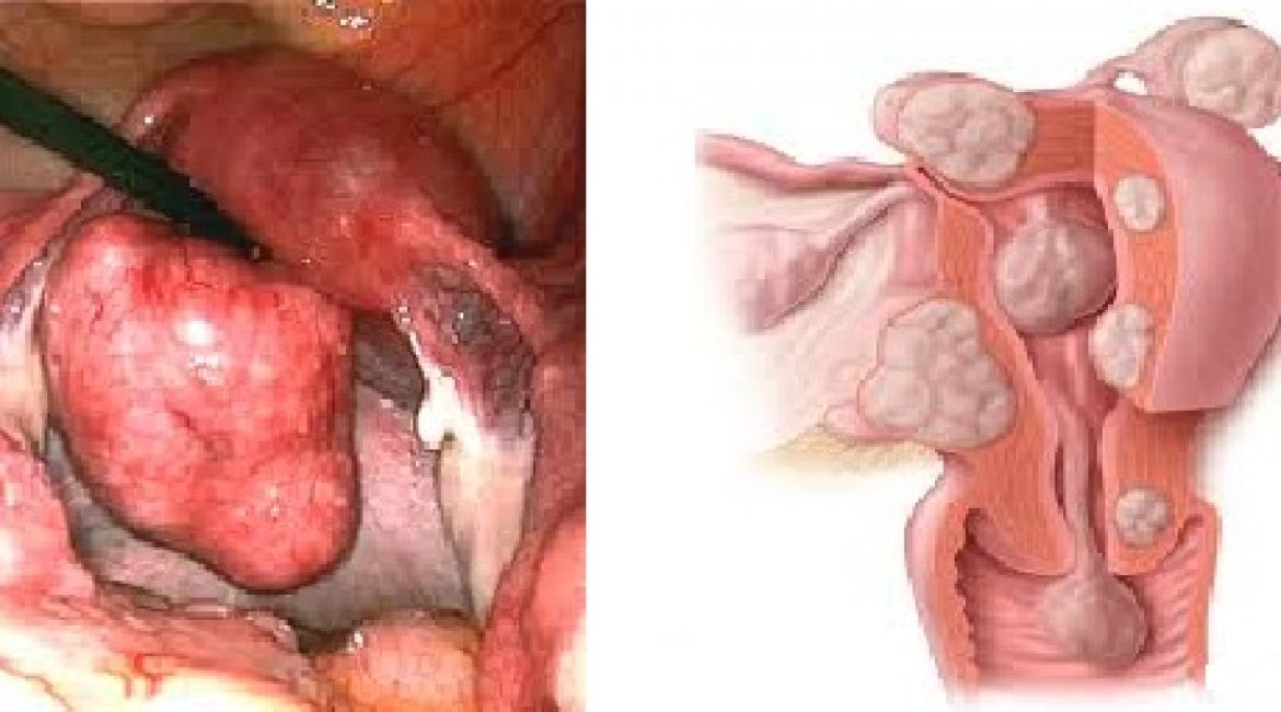 Fibroids