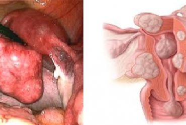 Fibroids