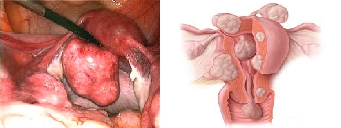 Fibroids